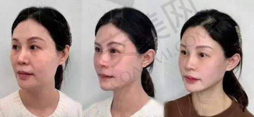 深圳富华注射玻尿酸价格包含哪些服务？