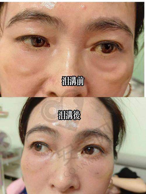 后续护理复杂吗？简单操作保成效