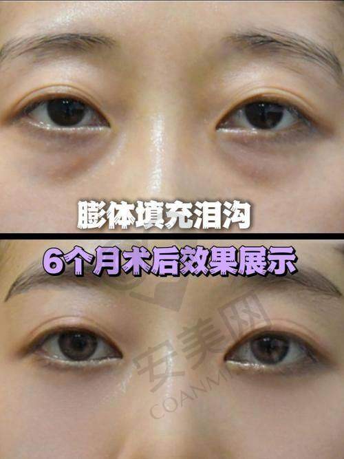 玻尿酸填充泪沟有啥特色？优势明显看得见