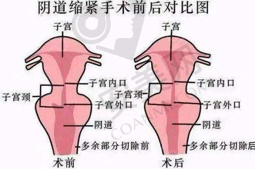 南京康美阴道紧缩术的手术过程是怎样的？