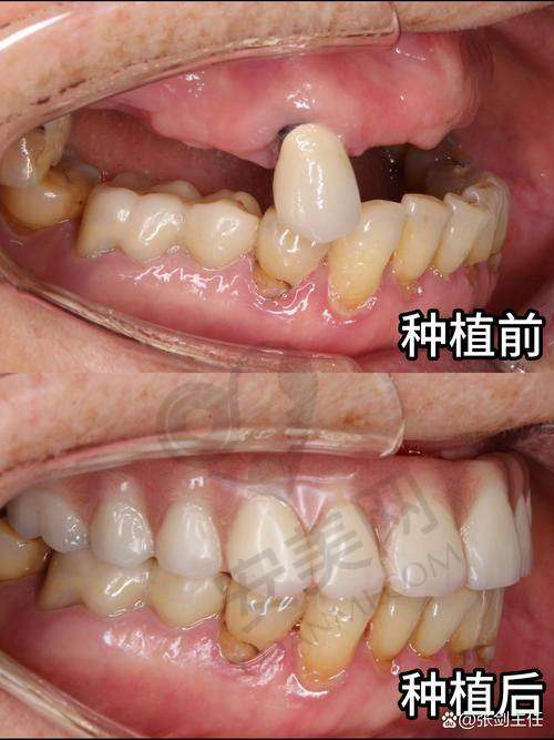 常熟明日口腔李永志医生种植牙怎么样？