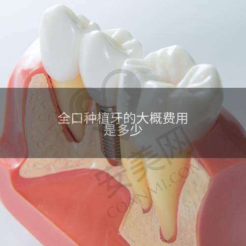 选择上饶牙博仕口腔进行 all - on - 4 即刻负重全口种植需要注意什么？