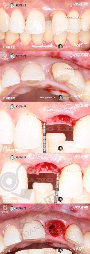 术后修复情况如何？