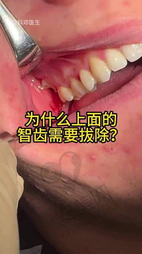 为什么要选择兰州齿语口腔拔智齿？