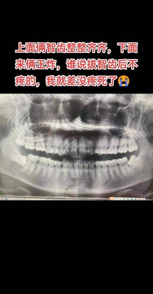 兰州齿语口腔智齿拔除技术有什么特色？