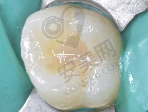 进口树脂z350补牙相比其他材料有哪些优势？