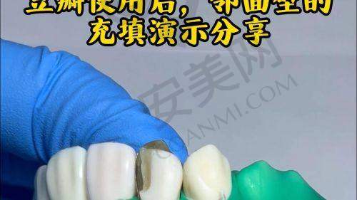 安阳植得口腔进口树脂z350补牙的价格情况是怎样的？