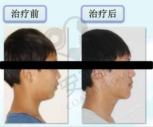 上海华美面部轮廓三件套适合哪些人？