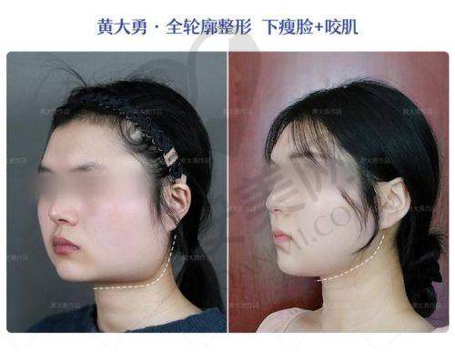 上海华美医院做面部轮廓三件套安心吗？