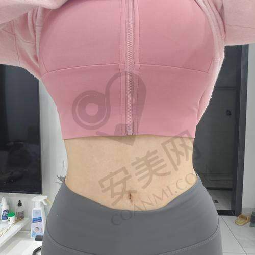 北京润美玉之光腰腹环吸是什么？靠谱吗？