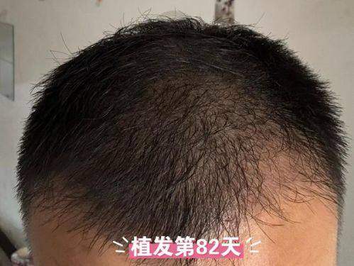 广州崇爱植发医院的环境与服务