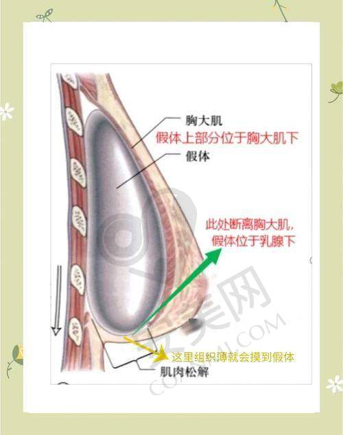 什么是曼托假体隆胸？