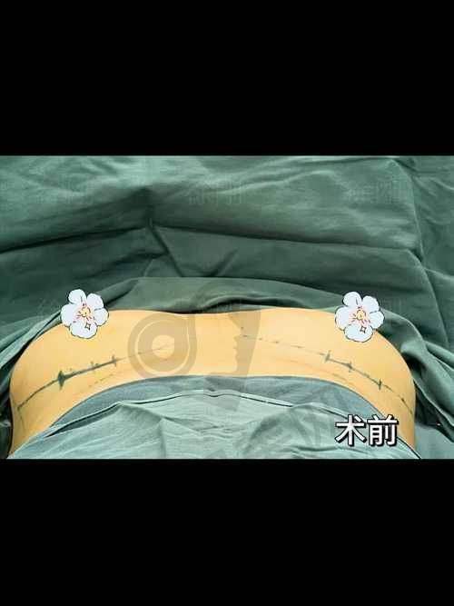 上海艺星的曼托假体隆胸优势在哪里？