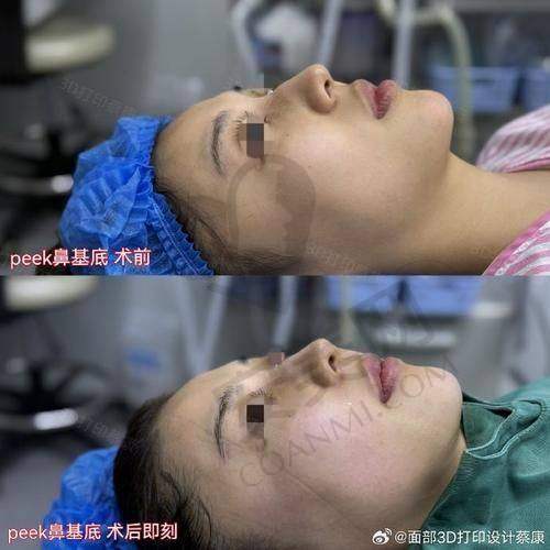 为什么会有人需要进行鼻整形假体取出？