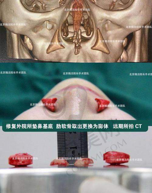 成都军大医院鼻整形假体取出的实例成效如何？