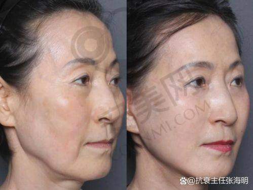 上海华美面部提升的技术水平如何？