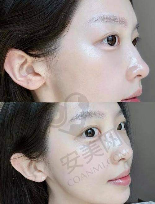 加强版VLine提升型脸型精细化雕刻的手术过程是怎样的？