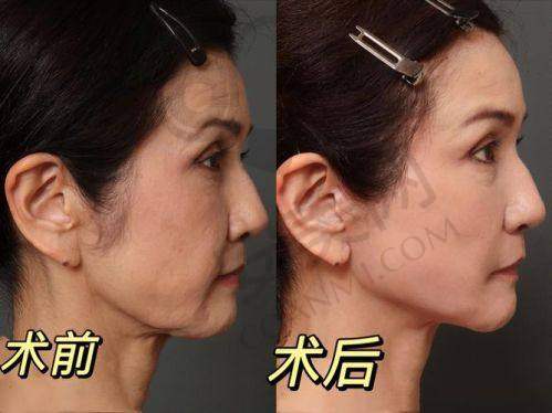 上海华美面部提升的价格是否合理？