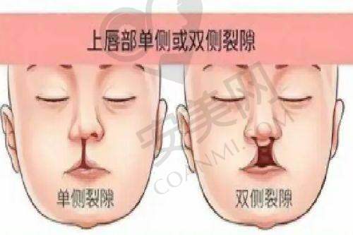广州高尚唇裂修复是否有后续保护？