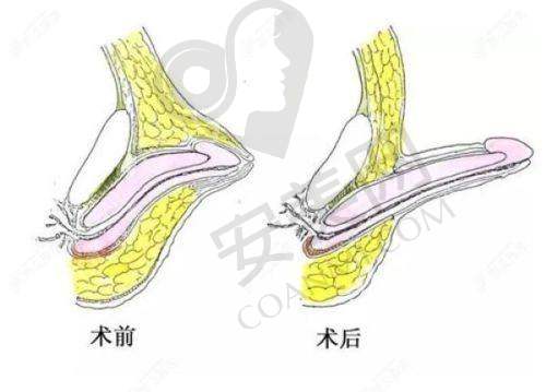 3、贵阳美莱左程医生整形技术怎么样？