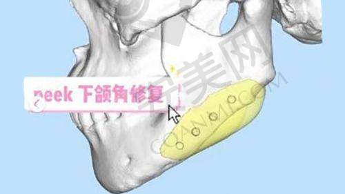 3、珠海如花霍旺佳医生整形技术怎么样？