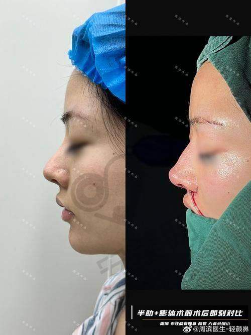 深圳艺星做鼻子的医生口碑如何？