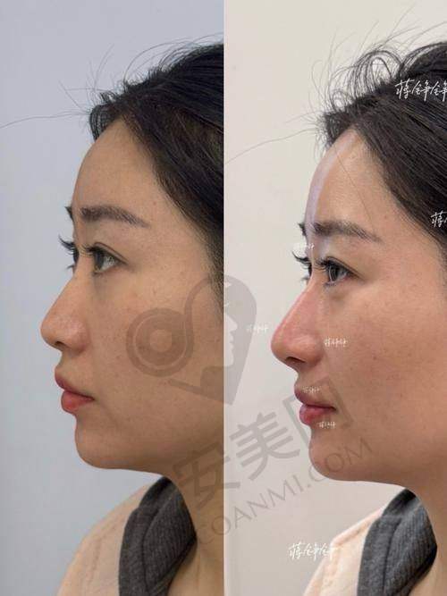 南京康美医院鼻综合整形适合哪些人群？