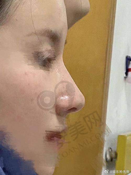 如何选择南京康美医院进行鼻综合整形？