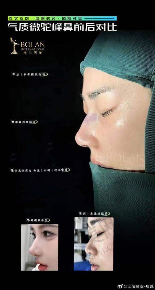 南京康美医院鼻综合整形的安心性如何？