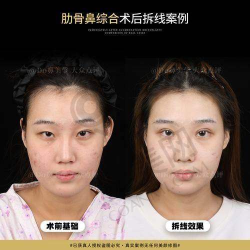 如何预约长沙艺脂李瑶医生的鼻子整形手术？