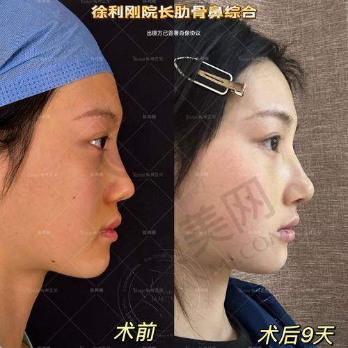 李瑶医生的鼻子整形价格合理吗？