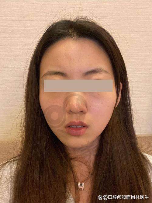 广州广大整形医院颧骨内推的优势有哪些？