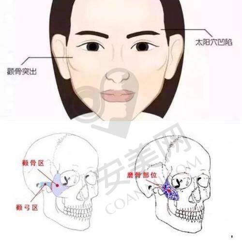 广州广大整形医院颧骨内推的成效如何？