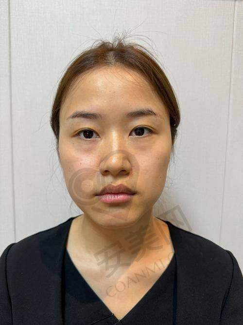西安画美在玻尿酸注射领域的地位如何？
