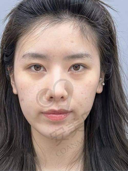 西安画美医生注射玻尿酸的成效能维持多久？