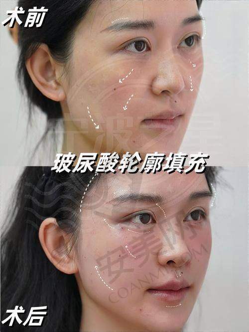 如何选择适合自己的西安画美注射玻尿酸医生？