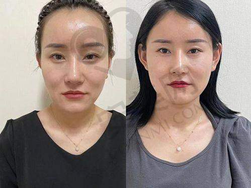 西安画美医生注射玻尿酸后有哪些注意事项？
