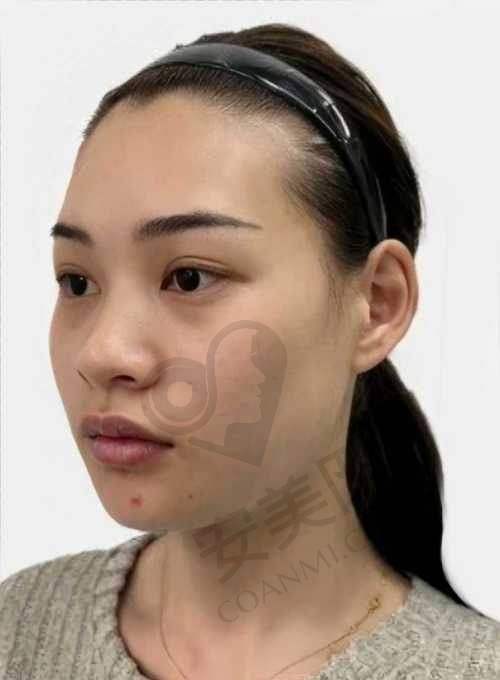 昆明韩辰医院玻尿酸注射去法令纹价格是怎样的？