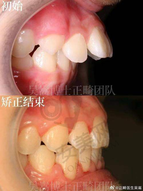 矫正过程中需要注意什么？