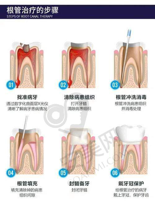 焦作军美口腔根管治疗的优势有哪些？