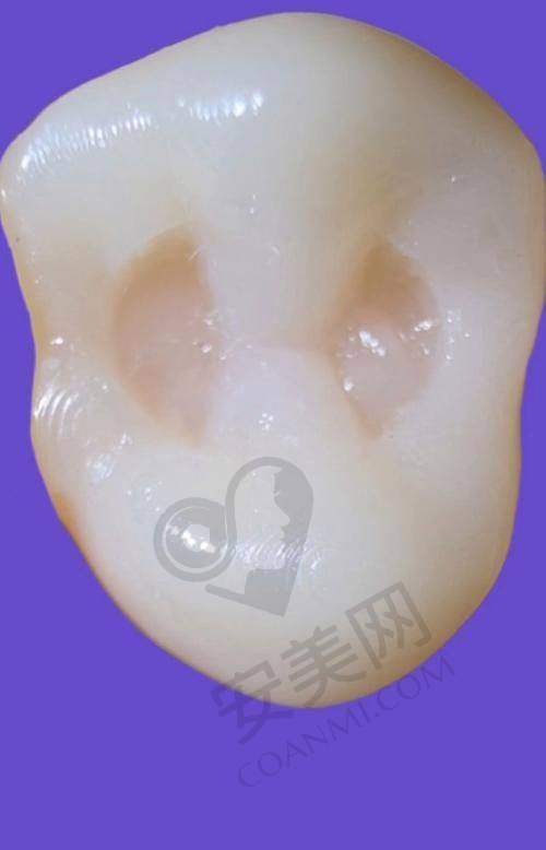 如何判断自己是否适合3M树脂补牙？