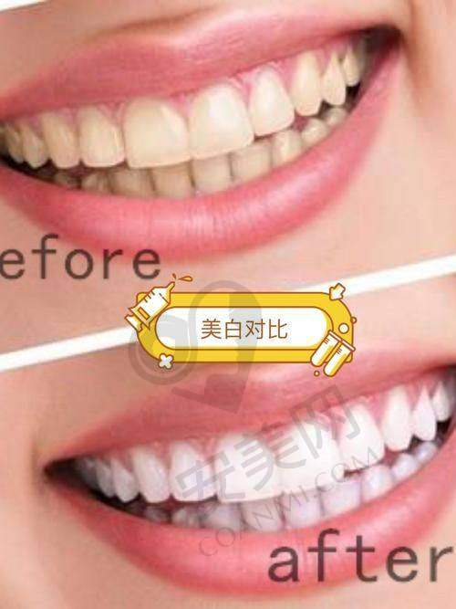 炫齿白项目4500元起的价格值得吗？