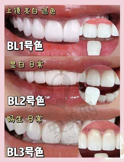 什么是牙齿贴面美白？