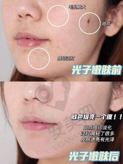 我的广州华美AOPT超光子就诊过程是怎样的？