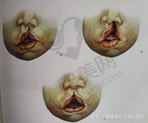 广州高尚唇裂修复的医生团队水平怎样？