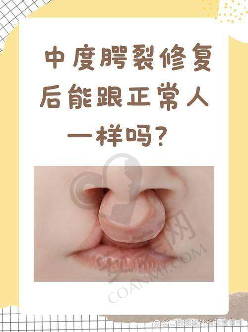广州高尚唇裂修复的修复成效能持续多久？
