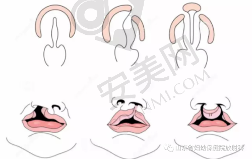 广州高尚唇裂修复与其他医院相比有什么优势？