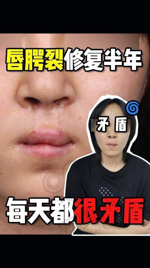 广州高尚唇裂修复的患者评价实例有哪些？