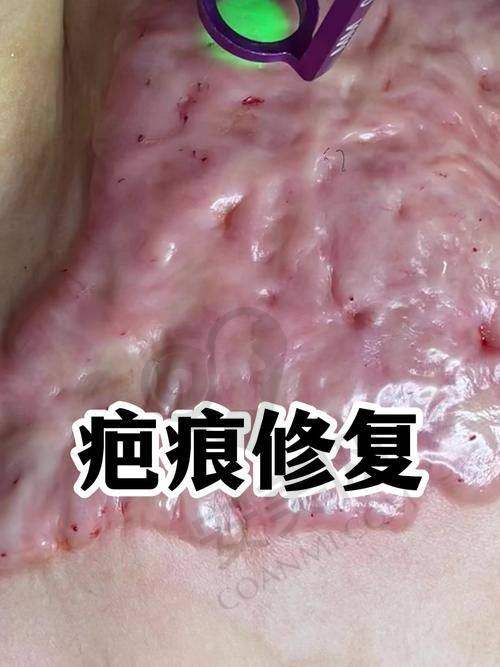 成都友谊医院疤痕科的基本情况是怎样的？