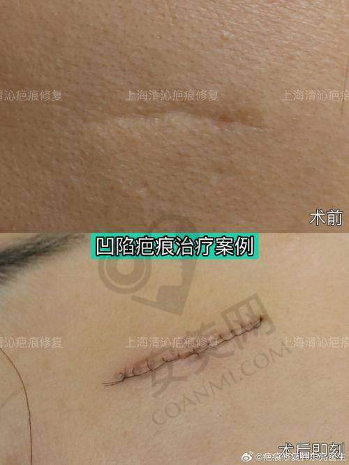 如何选择适合自己的疤痕治疗医院？